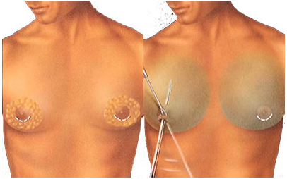 man boob reduction surgery tunisia